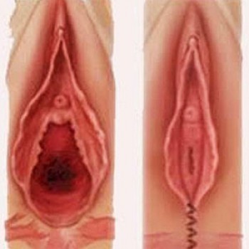 Cirurgia para Diminuir os Pequenos Lábios